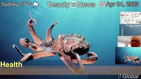 Major moment in MS research as new Octopus trial starts